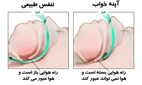 درمان جدید خروپف , sleep clinic in tehran , new Treating snoring and apnea